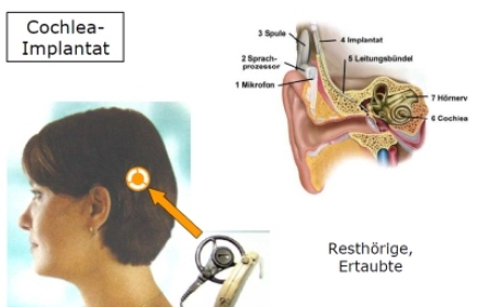 Das Cochlear-Implantat